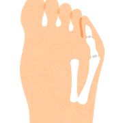小指の付け根が痛むのはなぜ 内反小趾の原因と治し方 外反母趾