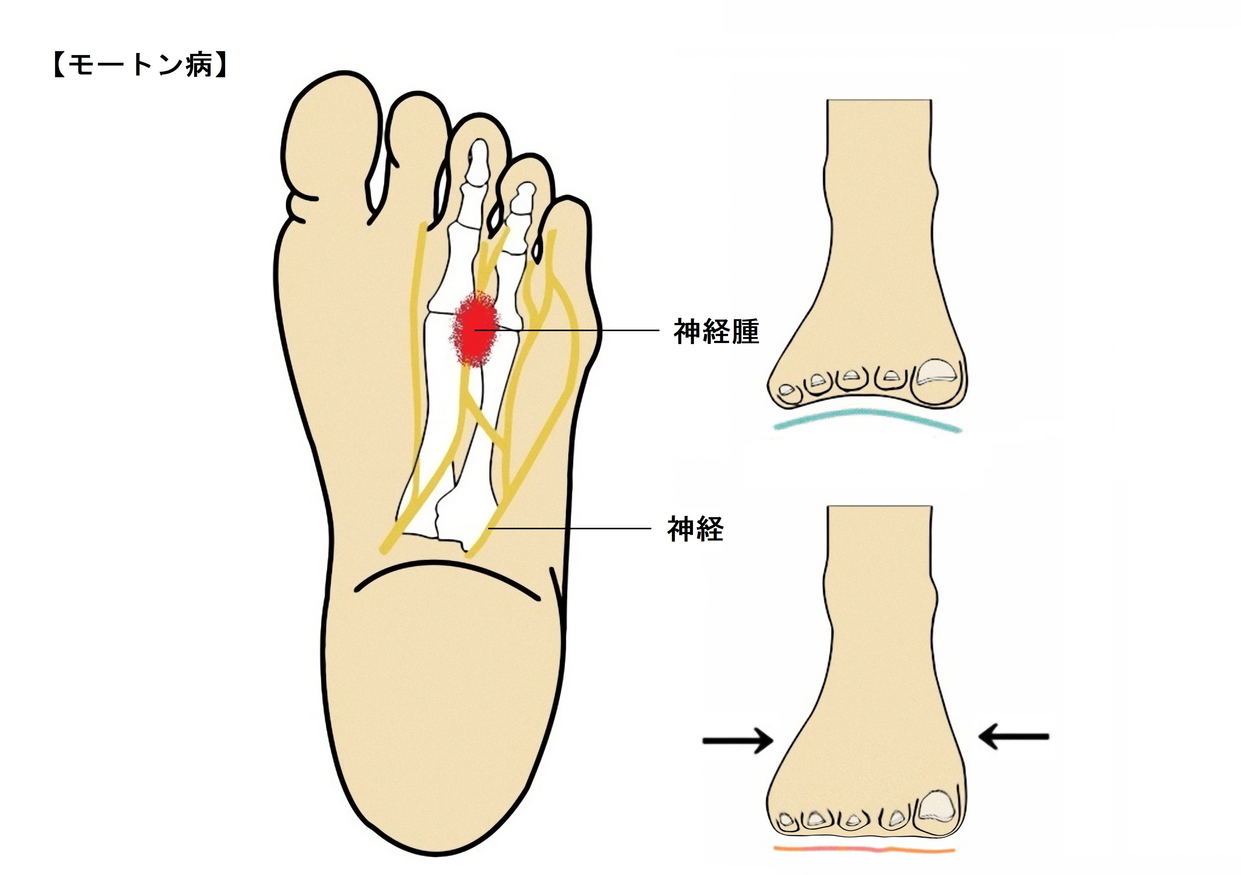 歩くと足の中指と薬指辺りがピリピリ痛い シビレが続く どうすればいいの 外反母趾